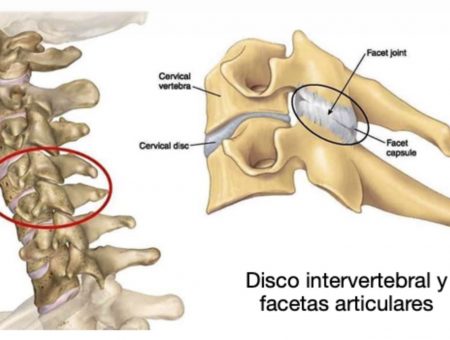 Síndrome facetario cervical degenerativo
